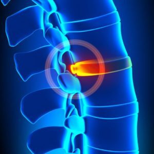 http://www.restoremydisc.com/wp-content/uploads/2016/08/cropped-spine-blue.jpg